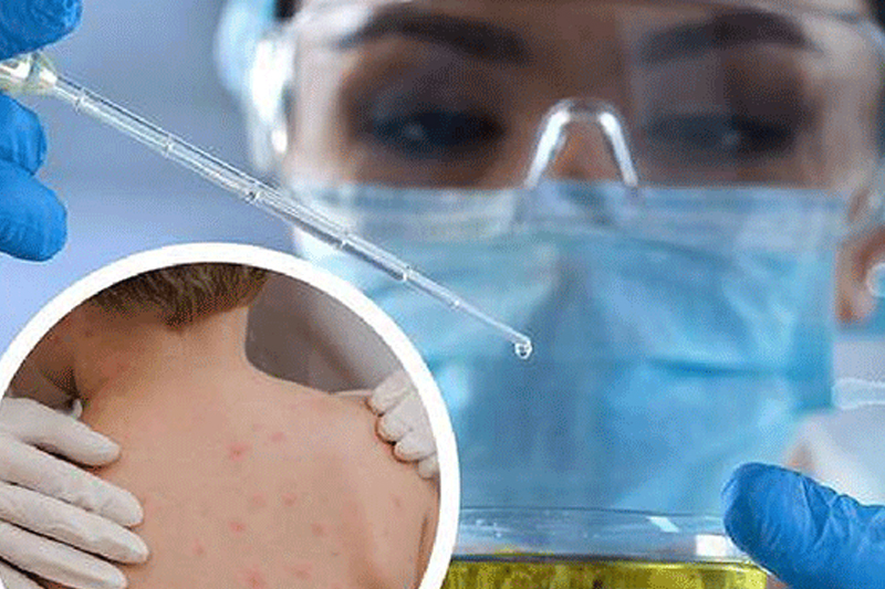 Plus de 200 cas confirmés de variole du singe dans