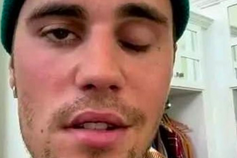 المغني العالمي جاستن بيبر يعلن إصابته بـ شلل نصفي فى وجهه – فيديو