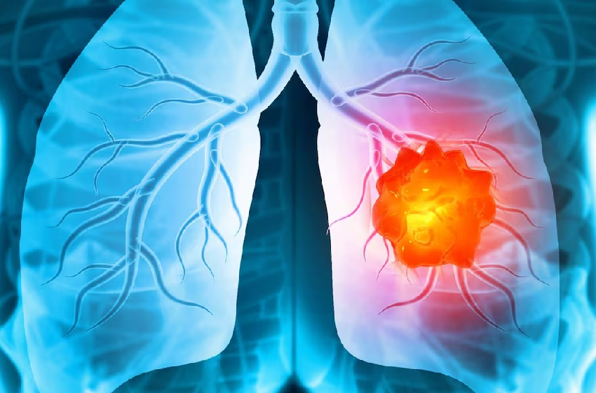 المبكر عامل حاسم في مكافحة سرطان الرئة مؤتمر